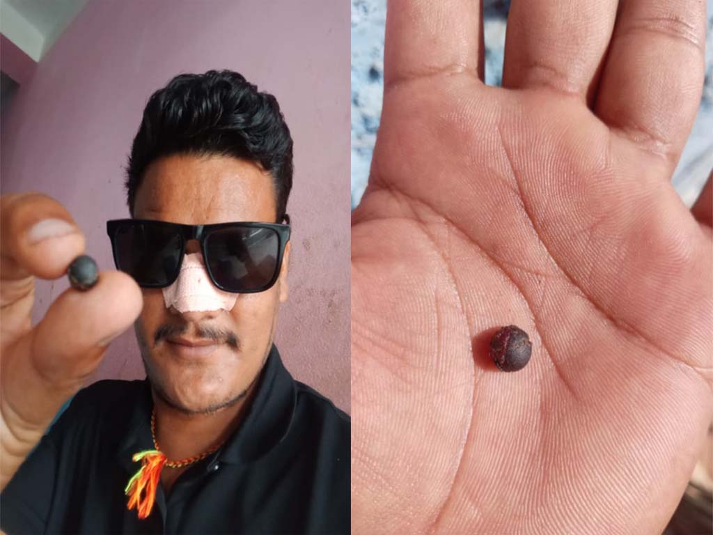 जेनजी आन्दोलनका घाइते दीपकको पीडा : एक महिनापछि नाकबाट निकालियो प्रहरीको गोली